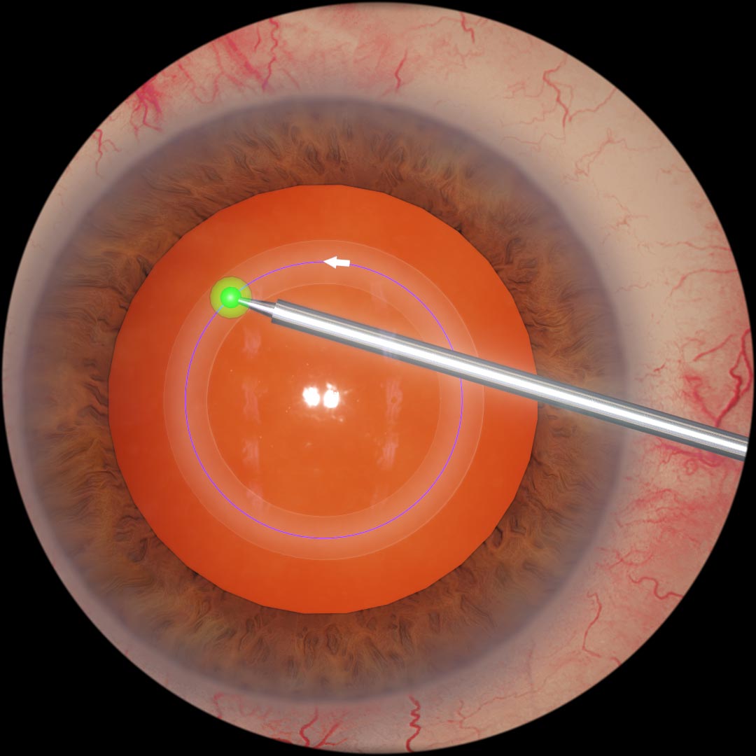 eyesiSurgical